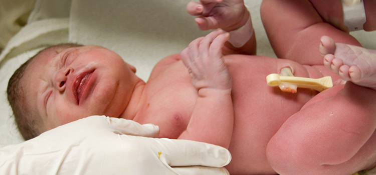 Neugeborenem wird nach der Geburt Nabelschnurblut aus der Nabelschnur entnommen